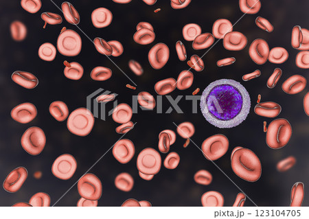 Iron deficiency anemia 123104705