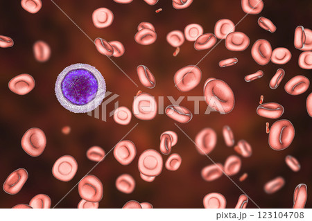 Iron deficiency anemia 123104708