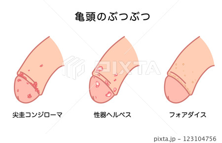 男性生殖器にできたぶつぶつ　性病の種類 123104756