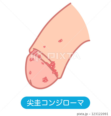 尖圭コンジローマ　男性生殖器にできたぶつぶつ 123122091