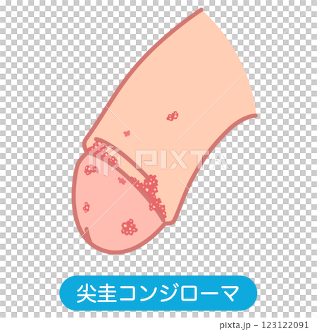 Genital warts: Bumps on the male genitals 123122091