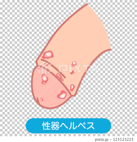 性器ヘルペス　男性生殖器にできたぶつぶつ 123123225