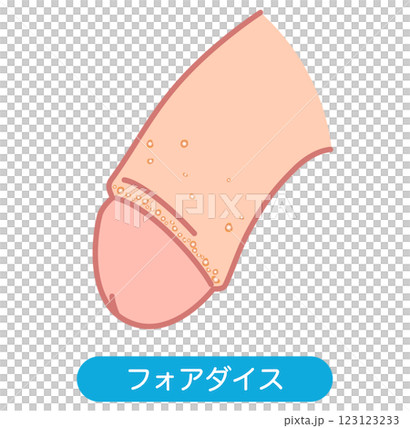 福代斯斑點：男性生殖器上的腫塊 123123233