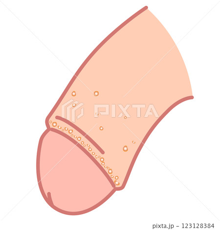 フォアダイス　男性生殖器にできたぶつぶつ 123128384
