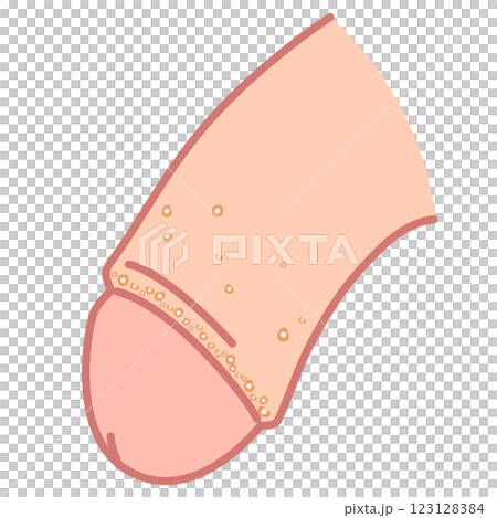 フォアダイス　男性生殖器にできたぶつぶつ 123128384