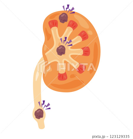 癌ができた腎臓のイラスト2 癌ができた腎臓のイラスト2 123129335