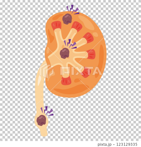 癌ができた腎臓のイラスト2 癌ができた腎臓のイラスト2 123129335