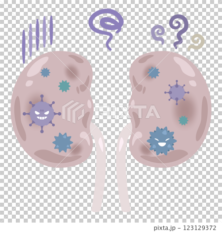 Illustration of a kidney infected with bacteria 2 123129372