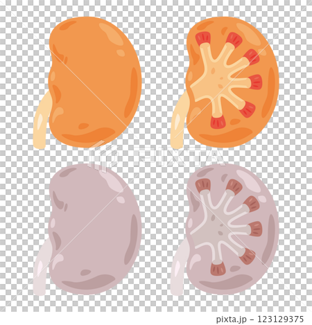 健康な腎臓と不健康な腎臓のイラスト 123129375