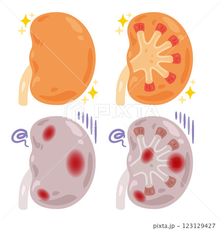 健康でキレイな腎臓と炎症が起きた不健康な腎臓のイラスト 123129427