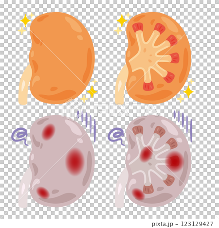 健康でキレイな腎臓と炎症が起きた不健康な腎臓のイラスト 123129427