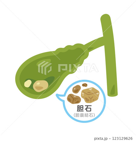胆石ができた胆嚢のイラスト2 123129626