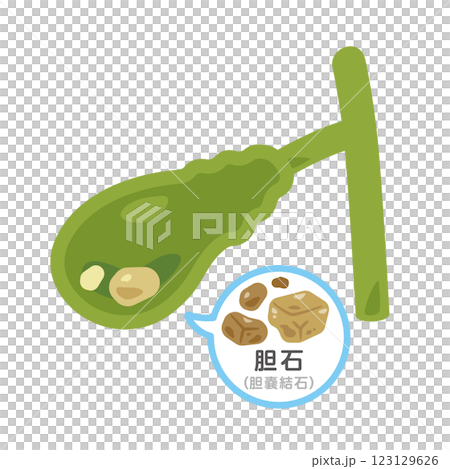 胆石ができた胆嚢のイラスト2 123129626