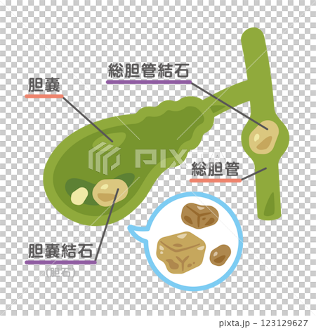 膽囊結石圖示 3 膽囊結石圖示 3 123129627