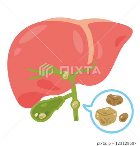 結石ができた胆嚢と肝臓のイラスト1 123129687