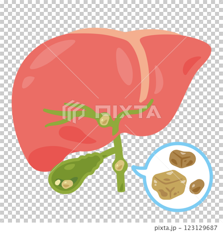 結石ができた胆嚢と肝臓のイラスト1 123129687