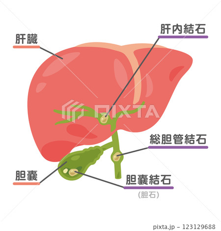 結石ができた胆嚢と肝臓のイラスト2 結石ができた胆嚢と肝臓のイラスト2 123129688