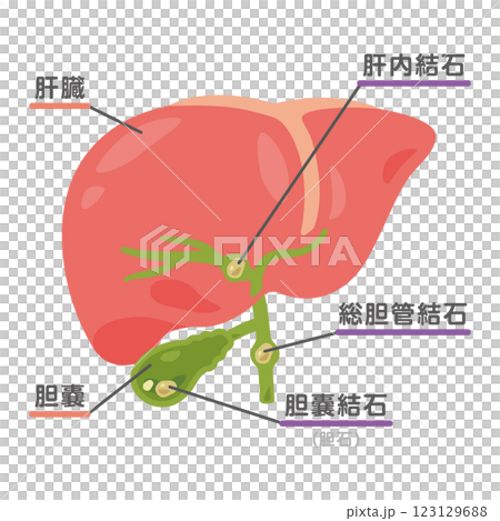 Illustration of the gallbladder and liver with stones 2 123129688