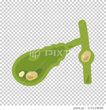 胆石ができた胆嚢のイラスト1 123129690