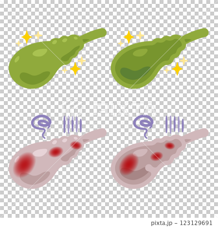 Illustration of a healthy and clean gallbladder and an inflamed and unhealthy gallbladder Illustration of a healthy and clean gallbladder and an inflamed and unhealthy gallbladder 123129691