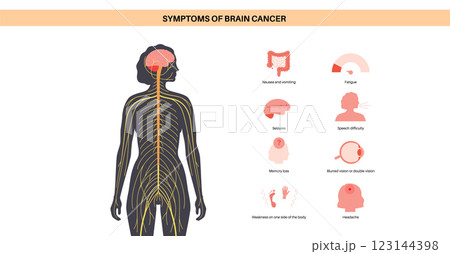 Primary brain tumors Primary brain tumors 123144398
