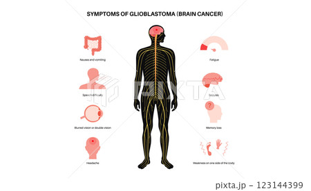 Primary brain tumors Primary brain tumors 123144399