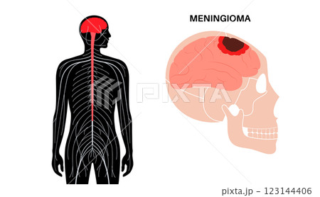 Meningioma cancer concept 123144406