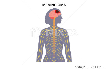 Meningioma cancer concept Meningioma cancer concept 123144409