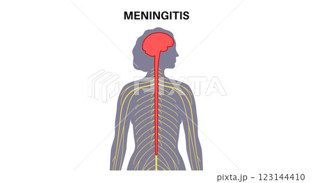 Meningitis medical poster Meningitis medical poster 123144410