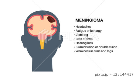 Meningioma cancer symptoms 123144417