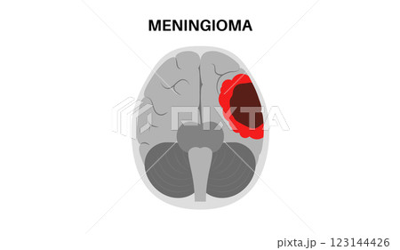 Meningioma cancer concept 123144426