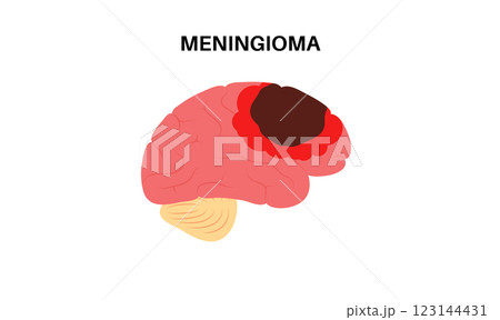 Meningioma cancer concept 123144431