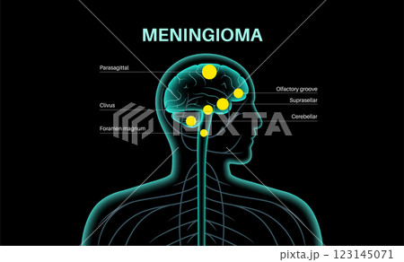 Meningiomas cancer poster 123145071