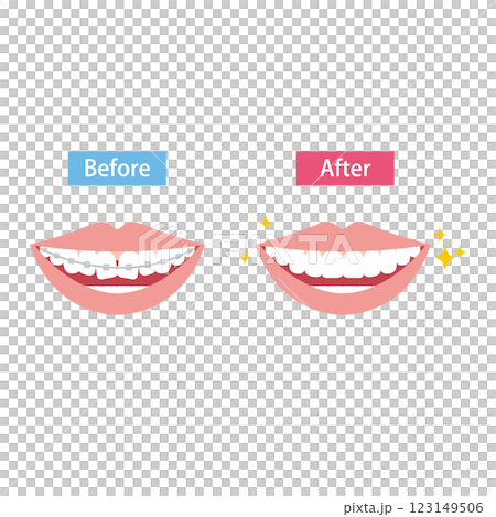 鋼絲矯正牙齒矯正前後比較圖 鋼絲矯正牙齒矯正前後比較圖 123149506