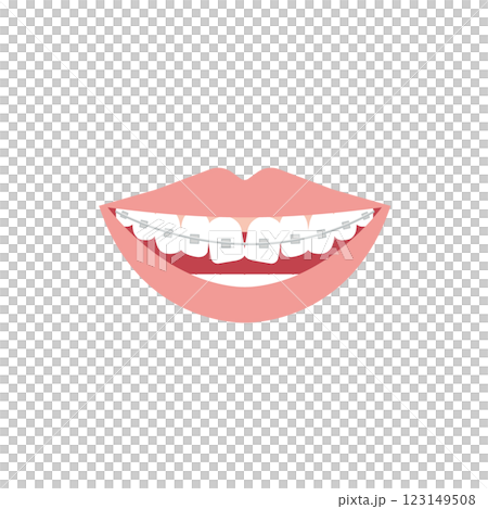 ワイヤー矯正した歯並びのイラスト 123149508