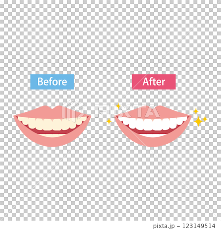 牙齒美白前後對比圖 123149514