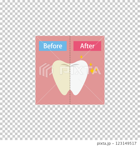 牙齒美白前後對比圖 123149517