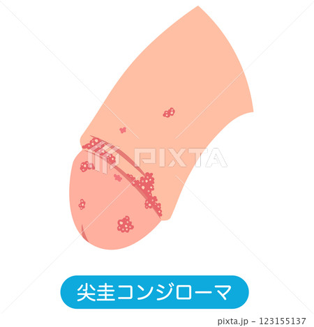 尖圭コンジローマ　男性生殖器にできたぶつぶつ 123155137