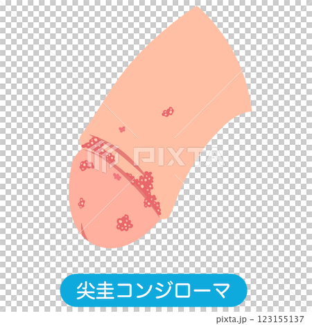 尖圭コンジローマ　男性生殖器にできたぶつぶつ 123155137