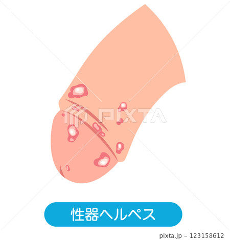 性器ヘルペス　男性生殖器にできたぶつぶつ 123158612