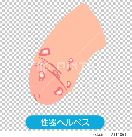 性器ヘルペス　男性生殖器にできたぶつぶつ 123158612