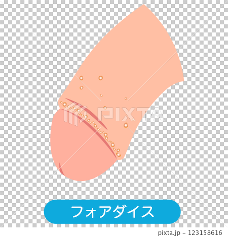 フォアダイス　男性生殖器にできたぶつぶつ 123158616