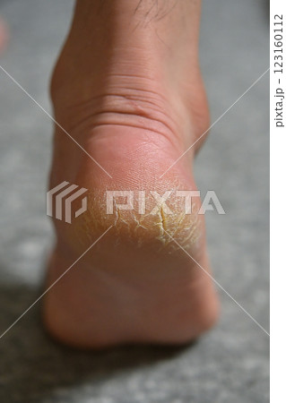 かかとのひびわれと角質と乾燥（ガサガサの踵のアップ） 123160112
