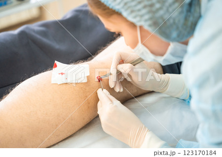 Dermatologist surgeon woman removes skin diseases with scalpel and tweezers, close up view of operation process Dermatologist surgeon woman removes skin diseases with scalpel and tweezers, close up view of operation process 123170184