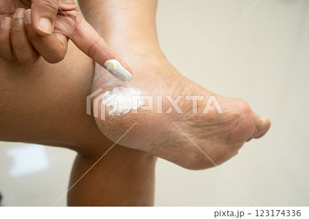Asian woman applying moisturizing cream skincare treatment to solve and repair feet with crack and dry heel skin. Asian woman applying moisturizing cream skincare treatment to solve and repair feet with crack and dry heel skin. 123174336
