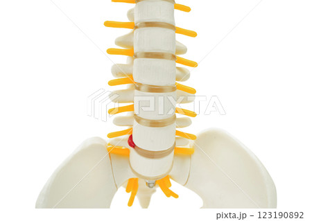 Spinal nerve and bone, Lumbar spine displaced herniated disc fragment, Model for treatment medical in the orthopedic department. 123190892