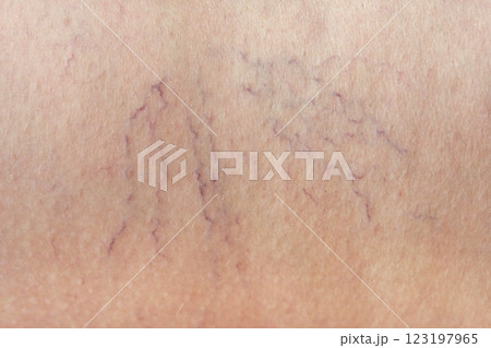 Close up of visible varicose veins on human skin showing vascular condition Close up of visible varicose veins on human skin showing vascular condition 123197965