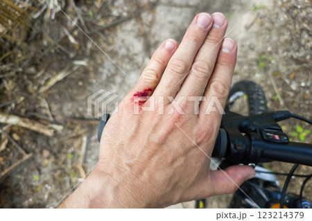 Arm injury while riding mountain bike on Florida jungle trails. Red bloody wound from hitting a tree stump. Biking accident Arm injury while riding mountain bike on Florida jungle trails. Red bloody wound from hitting a tree stump. Biking accident 123214379