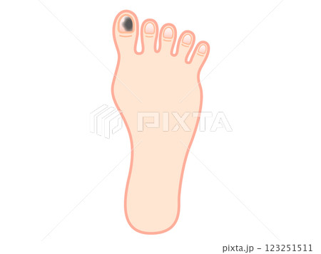 爪下血腫になった足の指のイラスト素材3 123251511