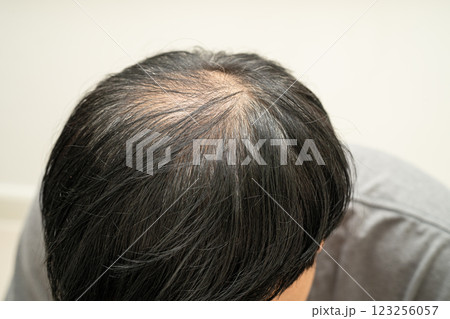 Bald head in man, hair loss treatment health problem. Bald head in man, hair loss treatment health problem. 123256057